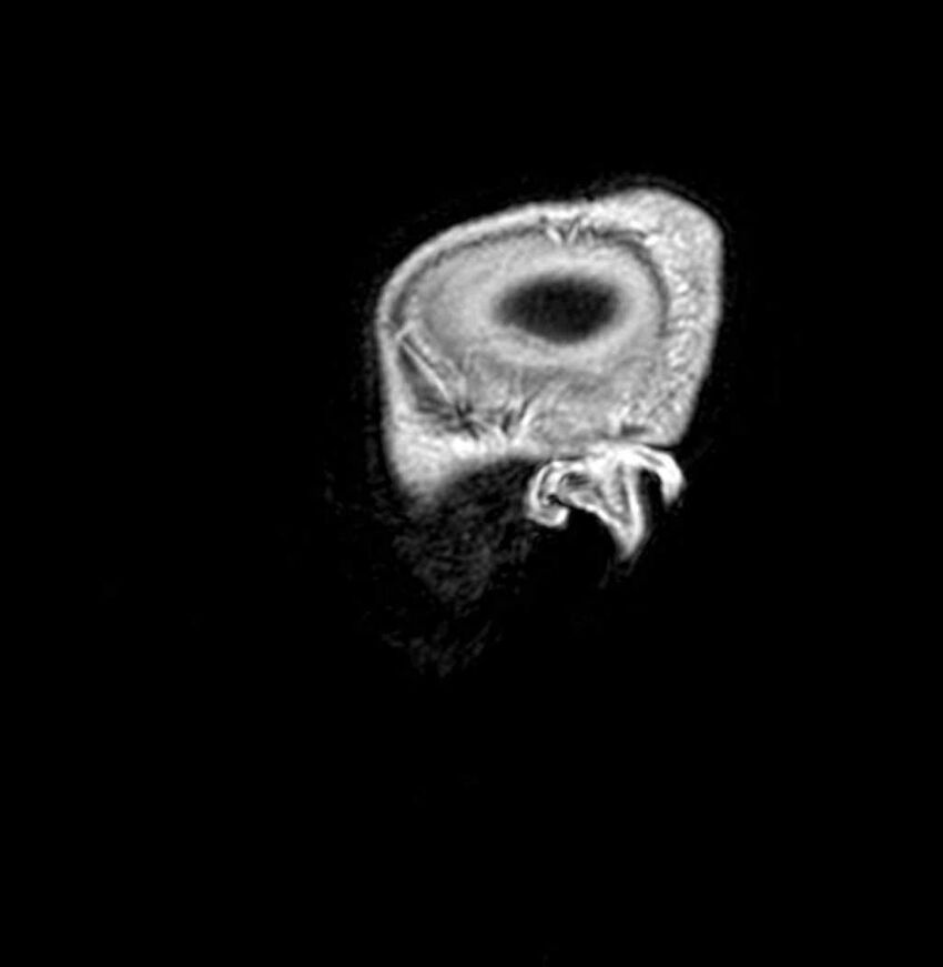 Arachnoid cyst- extremely large (Radiopaedia 68741-78451 Sagittal T1 C+ 73).jpg