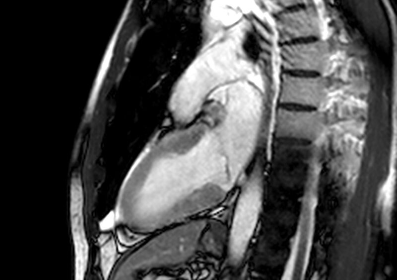 File:Arrhythmogenic right ventricular cardiomyopathy (Radiopaedia 39806-42237 B 8).jpg