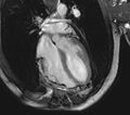 Arrhythmogenic right ventricular cardiomyopathy (Radiopaedia 39806-42237 D 23).jpg