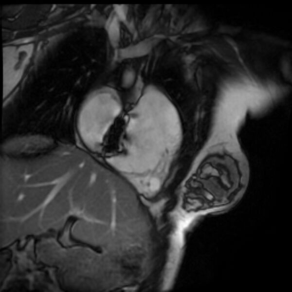 File:Arrhythmogenic right ventricular cardiomyopathy (Radiopaedia 87505-103850 2ch (RV) Cine SSFP 90).jpg