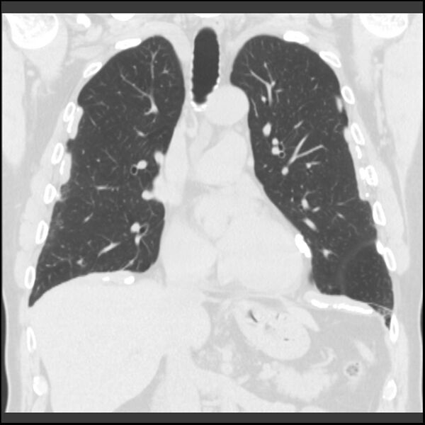File:Asbestos-related pleural plaques (Radiopaedia 39069-41255 Coronal lung window 51).jpg