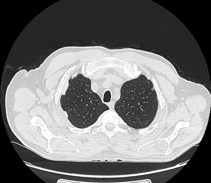 File:Asbestos pleural placques (Radiopaedia 57905-64872 Axial lung window 47).jpg