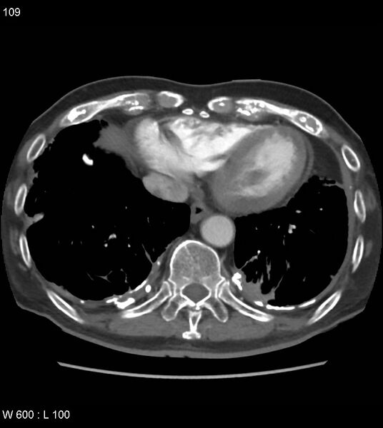 File:Asbestos related lung and pleural disease (Radiopaedia 14377-14301 D 45).jpg