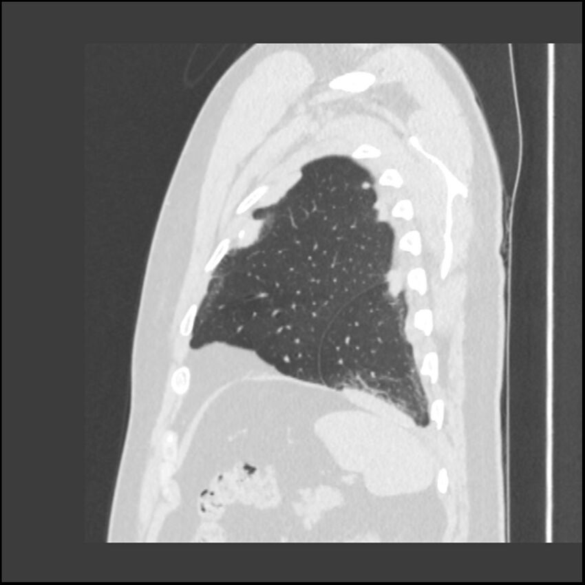 Asbestosis (Radiopaedia 45002-48961 Sagittal lung window 20).jpg