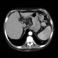 Atrophic polycystic kidneys and Alport syndrome (Radiopaedia 11099).jpg