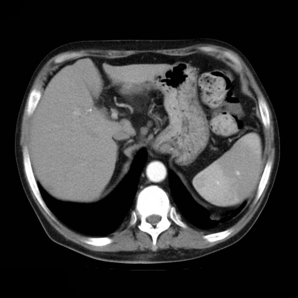 File:Atrophic polycystic kidneys and Alport syndrome (Radiopaedia 11099).jpg