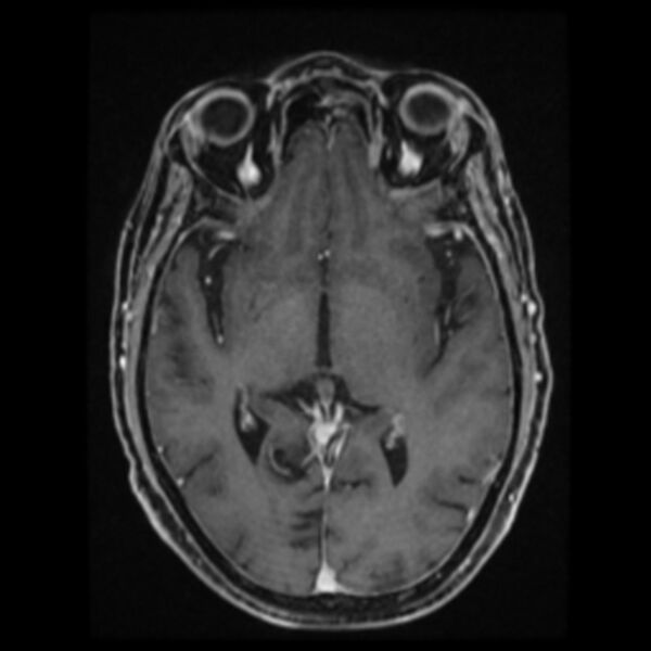 File:Atypical meningioma (Radiopaedia 45535-49629 Axial T1 C+ 36).jpg