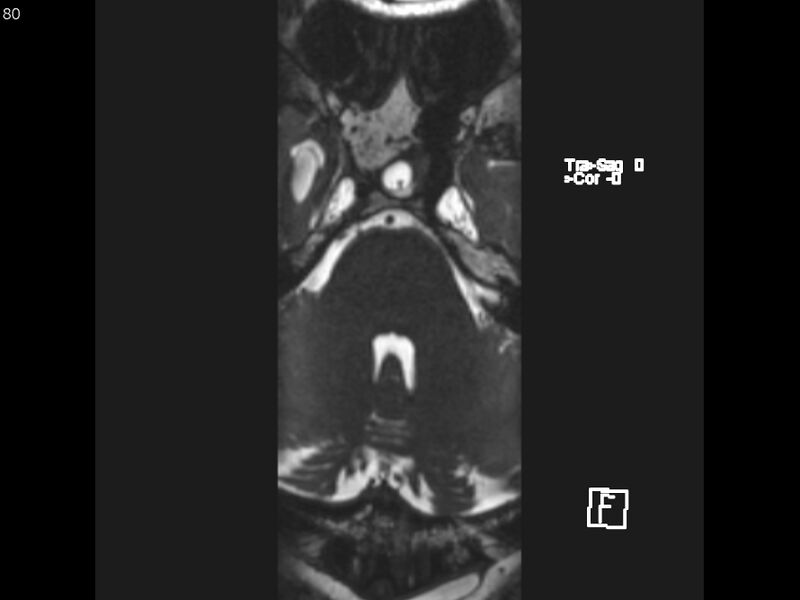 File:Atypical meningioma - intraosseous (Radiopaedia 64915-74572 Axial CISS 80).jpg