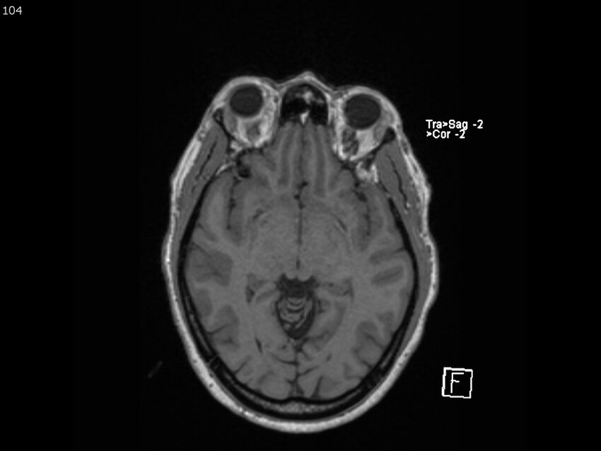 Atypical meningioma - intraosseous (Radiopaedia 64915-74572 Axial T1 104).jpg