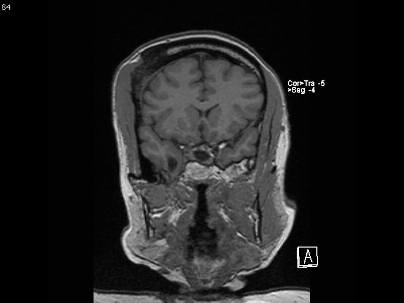 File:Atypical meningioma - intraosseous (Radiopaedia 64915-74572 Coronal T1 84).jpg