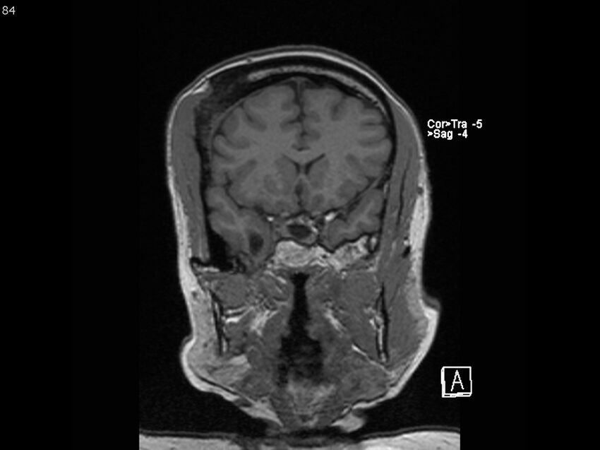 Atypical meningioma - intraosseous (Radiopaedia 64915-74572 Coronal T1 84).jpg