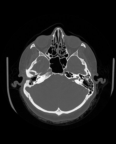 File:Automastoidectomy with labyrinthine fistula (Radiopaedia 84143-99411 Axial non-contrast 87).jpg