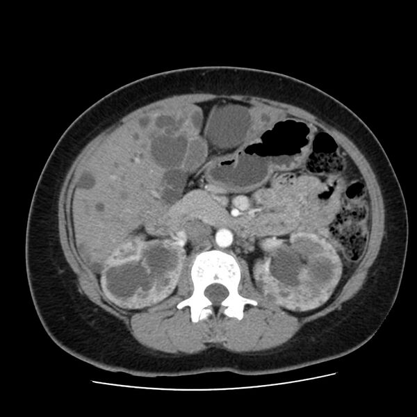 File:Autosomal dominant polycystic kidney disease (Radiopaedia 23061-23093 B 27).jpg