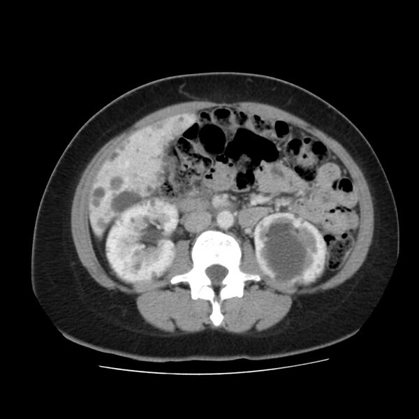 File:Autosomal dominant polycystic kidney disease (Radiopaedia 23061-23093 C 32).jpg