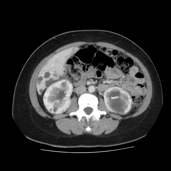 File:Autosomal dominant polycystic kidney disease (Radiopaedia 23061-23093 C 33).jpg