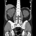 Autosomal dominant polycystic kidney disease (Radiopaedia 36539-38101 C 50).jpg
