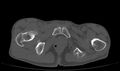 Avascular necrosis of the left hip (Radiopaedia 75068-86125 Axial bone window 85).jpg