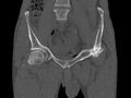 Avascular necrosis of the left hip (Radiopaedia 75068-86125 Coronal bone window 6).jpg