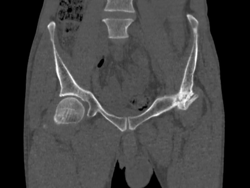 File:Avascular necrosis of the left hip (Radiopaedia 75068-86125 Coronal bone window 6).jpg