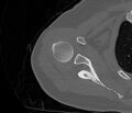 Avulsion fracture - greater tuberosity of humerus (Radiopaedia 71216-81514 Axial bone window 30).jpg