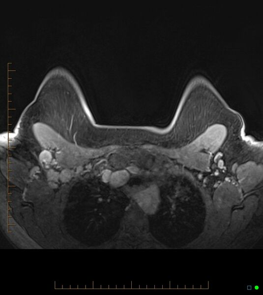 File:Axillary lymphadenopathy on breast MRI- yellow fever vaccination induced (Radiopaedia 19454-19483 Axial T1 C+ fat sat 15).jpg
