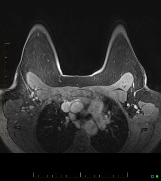 File:Axillary lymphadenopathy on breast MRI- yellow fever vaccination induced (Radiopaedia 19454-19483 Axial T1 C+ fat sat 24).jpg