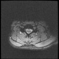 Axis fracture - MRI (Radiopaedia 71925-82375 Axial T2 fat sat 16).jpg
