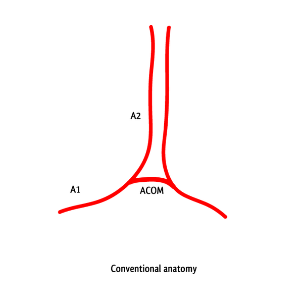 File:Azygos anterior cerebral artery (illustration) (Radiopaedia 10771-11230 Conventional anatomy 1).png