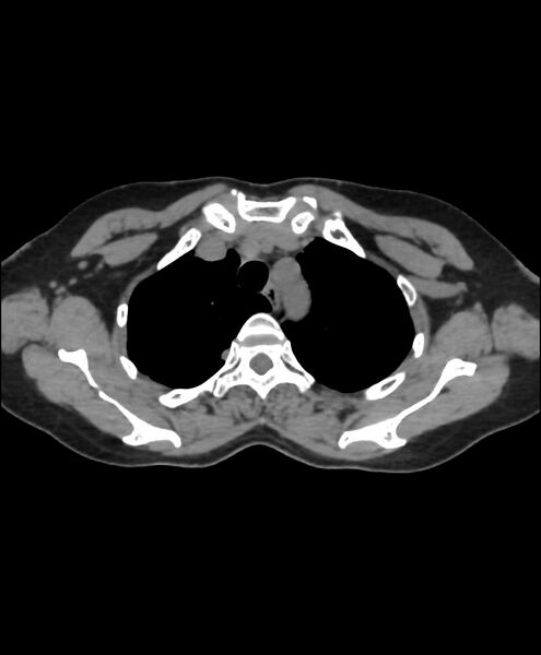 File:Azygos fissure and azygos lobe (Radiopaedia 41841-44832 Axial non-contrast 7).jpg