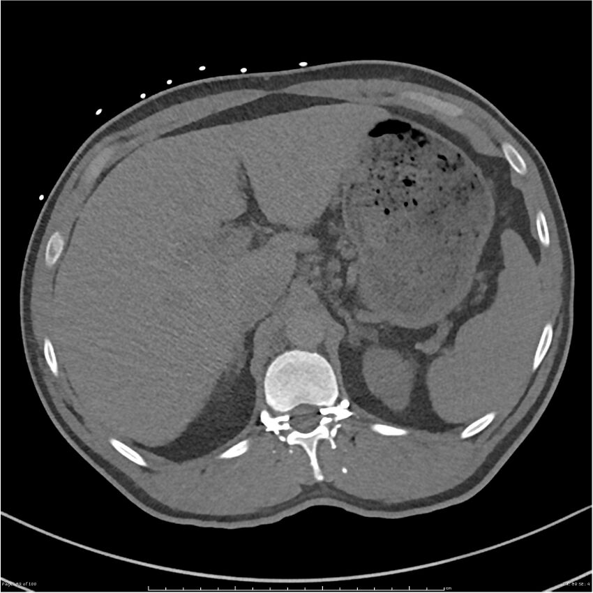 Azygos venous system anatomy (CT pulmonary angiography) (Radiopaedia 25928-26077 Axial C+ CTPA 89).jpg
