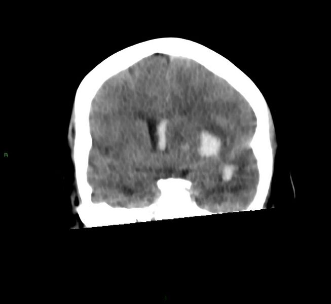 File:Basal ganglia hemorrhage (Radiopaedia 58759-65981 Coronal non-contrast 44).jpg