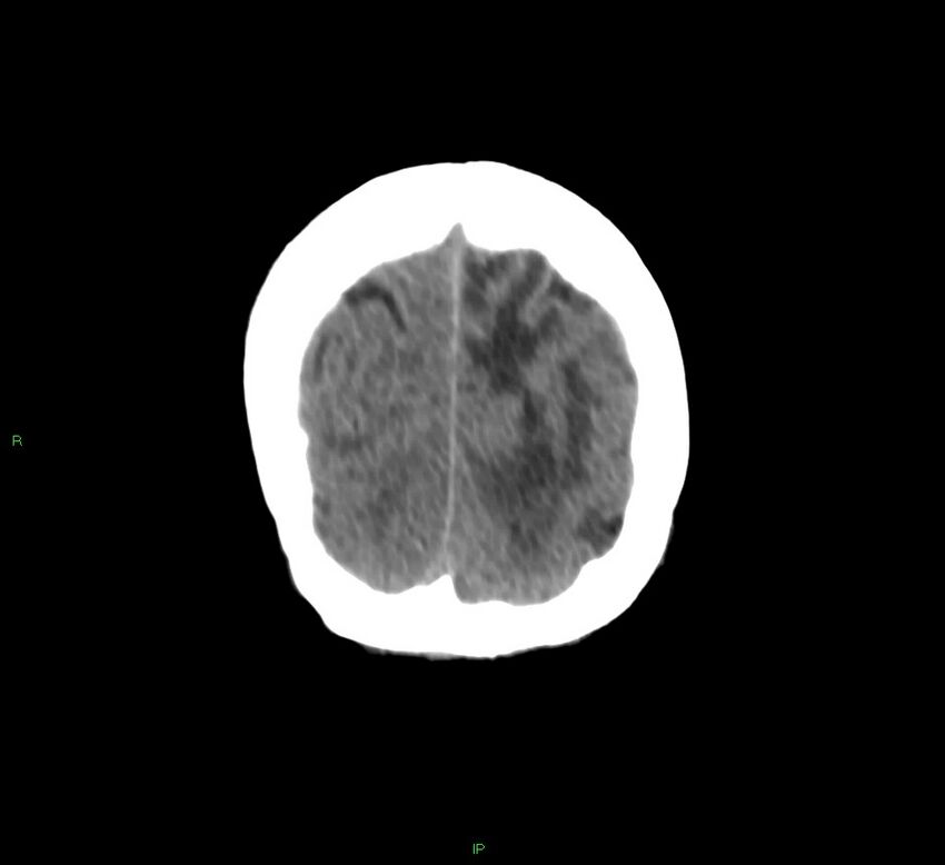 Basal ganglia hemorrhage (Radiopaedia 58766-65988 Coronal non-contrast 12).jpg