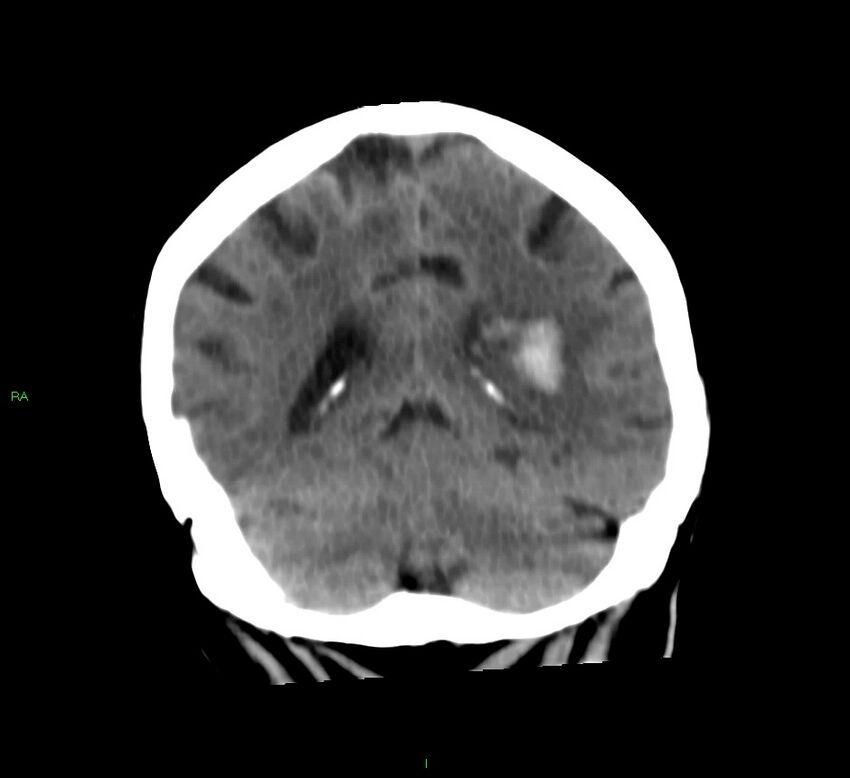 Basal ganglia hemorrhage (Radiopaedia 58790-66024 Coronal non-contrast 19).jpg