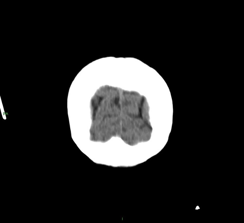Basal ganglia hemorrhage (Radiopaedia 58790-66024 Coronal non-contrast 5).jpg