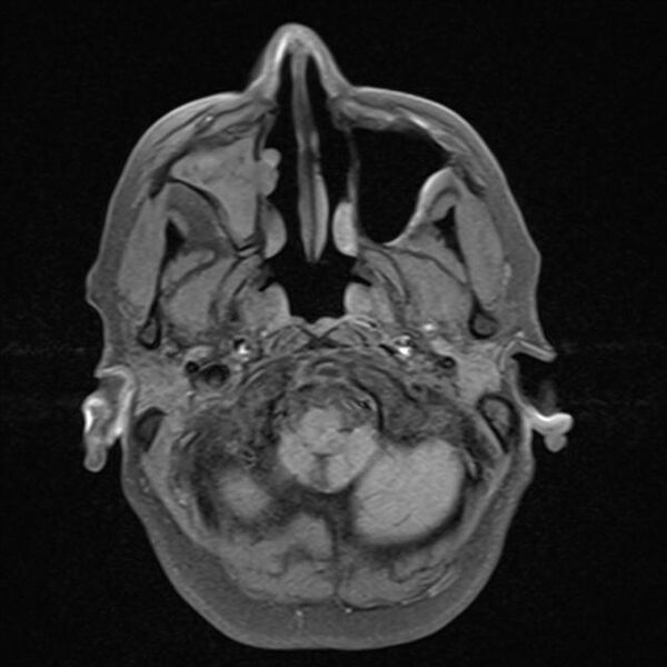 File:Base of skull chondrosarcoma (Radiopaedia 30410-31070 Axial T1 fat sat 2).jpg