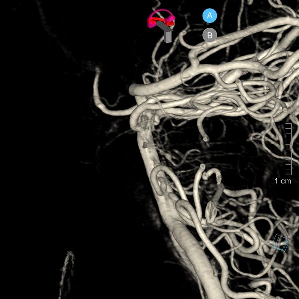 File:Basilar artery perforator aneurysm (Radiopaedia 82455-97734 3D view left VA 17).jpg