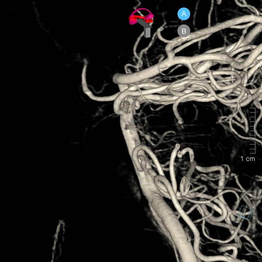 Basilar artery perforator aneurysm (Radiopaedia 82455-97734 3D view left VA 17).jpg