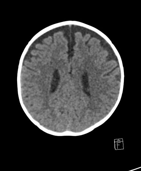 File:Benign enlargement of subarachnoid spaces in infancy (BESS) (Radiopaedia 87459-103795 Axial non-contrast 32).jpg