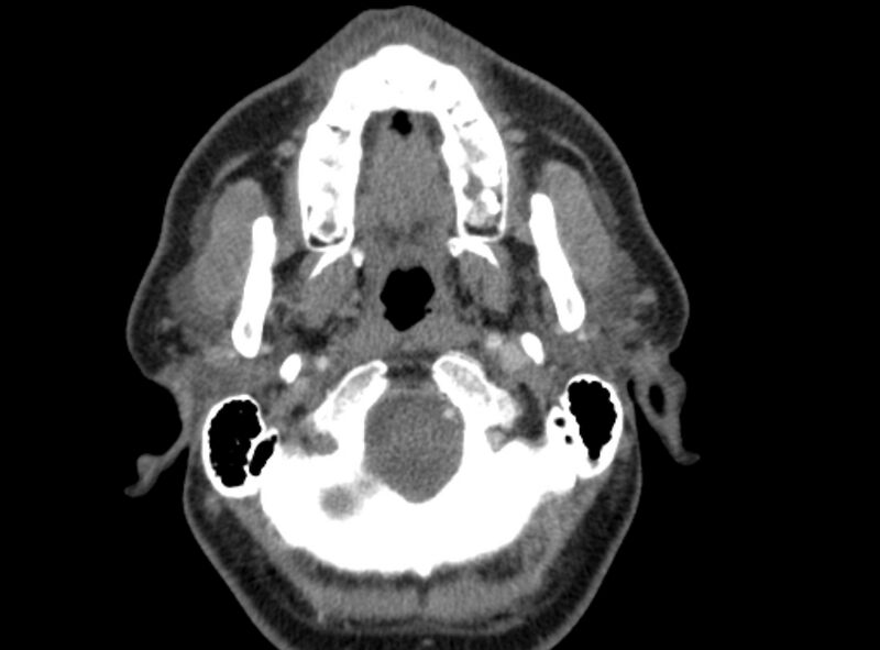 File:Benign mixed salivary tumor of the parotid gland (Radiopaedia 35261-36792 A 14).jpg
