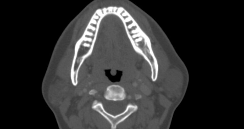 File:Benign mixed salivary tumor of the parotid gland (Radiopaedia 35261-36792 Axial bone window 22).jpg