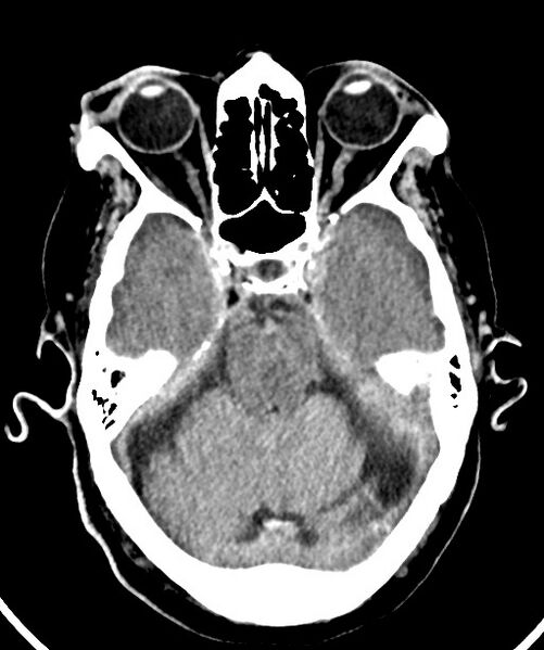 File:Bilateral acute on chronic subdural hematomas (Radiopaedia 78466-91146 Axial non-contrast 21).jpg
