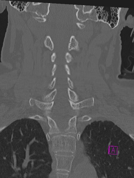 File:Bilateral atlanto-occipital assimilation (Radiopaedia 28350-28603 Coronal bone window 25).jpg