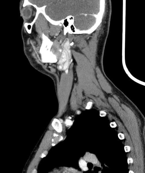 File:Bilateral carotid body tumors (Radiopaedia 52899-58827 C 45).jpg