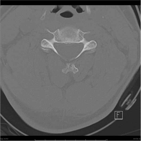 File:Bilateral cervical ribs (Radiopaedia 25868-26017 Axial bone window 24).jpg