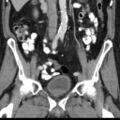 Bilateral direct inguinal herniae (Radiopaedia 17016-16719 A 19).jpg