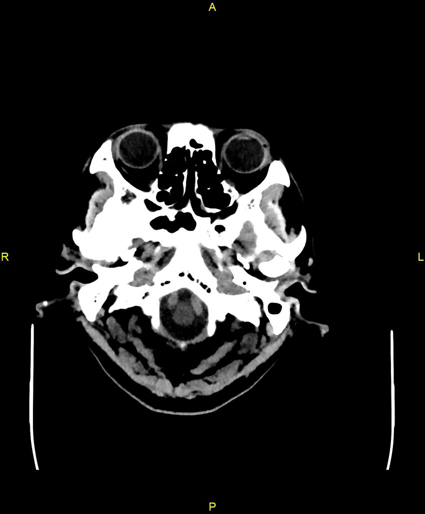 Bilateral isodense subdural hematomas (Radiopaedia 88621-105325 Axial non-contrast 9).jpg