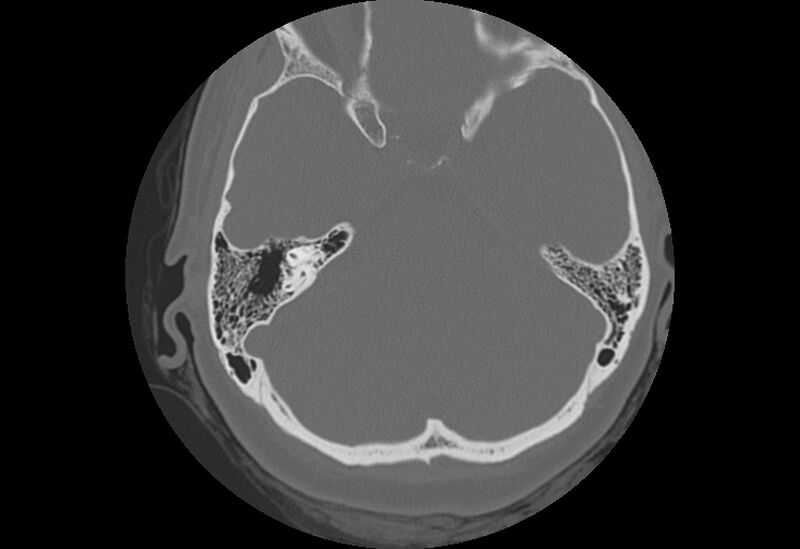 File:Bilateral otospongiosis (Radiopaedia 35447-36940 Axial bone window 41).jpg