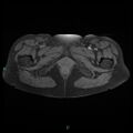 Bilateral ovarian fibroma (Radiopaedia 44568-48293 Axial T1 fat sat 29).jpg