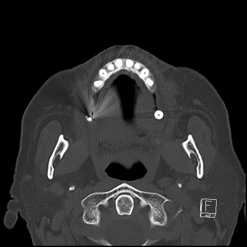 Bilateral palatine tonsilloliths on OPG and CT (Radiopaedia 75167-86247 Axial bone window 35).jpg