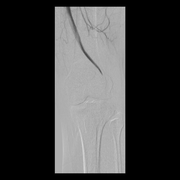 File:Bilateral popliteal artery entrapment (dynamic angiogram) (Radiopaedia 9420-10104 C 1).jpg
